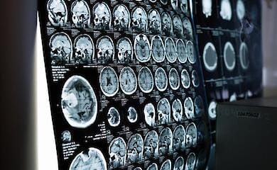 Anorexia can have a critical effect on the brain