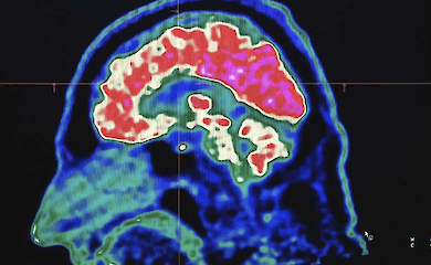Microplastics have made it to the brain - what science knows about it