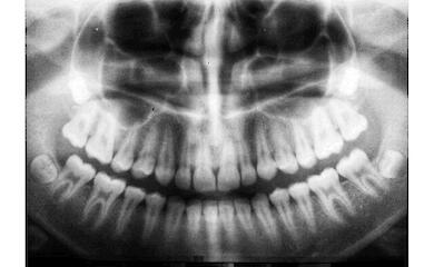 How dental root canal treatment affects blood sugar