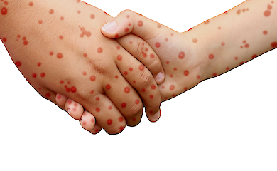 Wzrost zatruć witaminą A w USA w związku z wybuchem epidemii odry