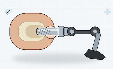 A schematic illustration of an osseointegrated prosthesis: a metal implant is fixed within the bone and connected to an external prosthesis.